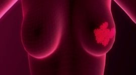 Cancro da mama, o inimigo número 1 das mulheres